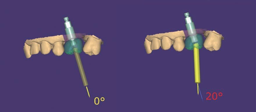 Fig. 10 - Spostamento del canale della vite.