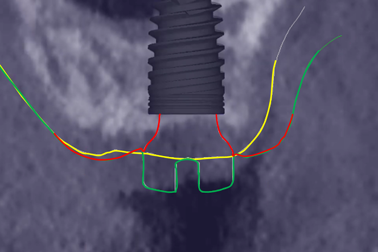 Fig. 4c: Drawing of the shape of the peri-implant gingiva around the healing abutment (red lines) after merging of the STL file of the implant. 