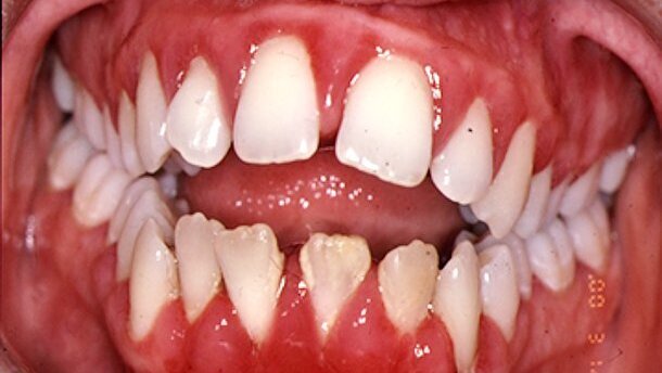 Les bactéries de la bouche accélèrent le développement de la maladie des gencives
