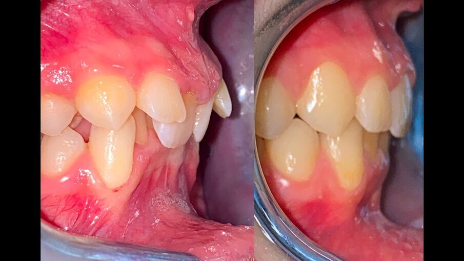 Fig. 23_Laterale pre e post-trattamento.