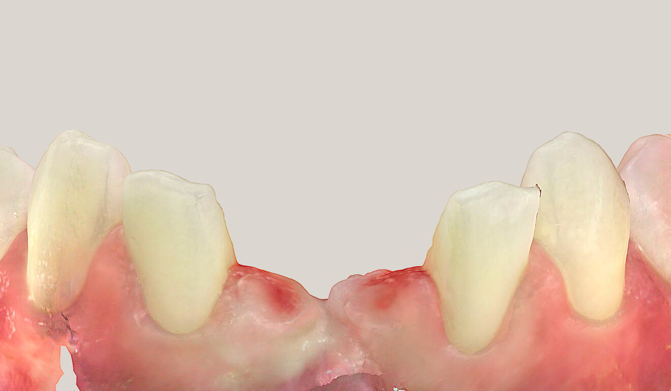 Fig. 3: Intra-oral scan after bridge removal and minimal preparation of the lingual surfaces of the abutment teeth.
