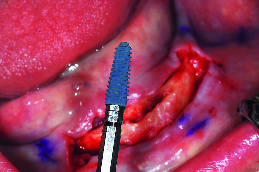 Fig. 16a: The thread design of the AnyRidge implant (a), four implants well-fixated in the mandibular symphysis (b).