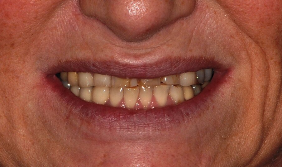 Fig. 15: Preoperative smile and lip profile