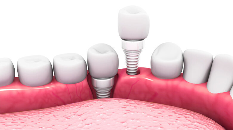 Nanokeramik aus der Kugelmühle für stabilere Zahnimplantate