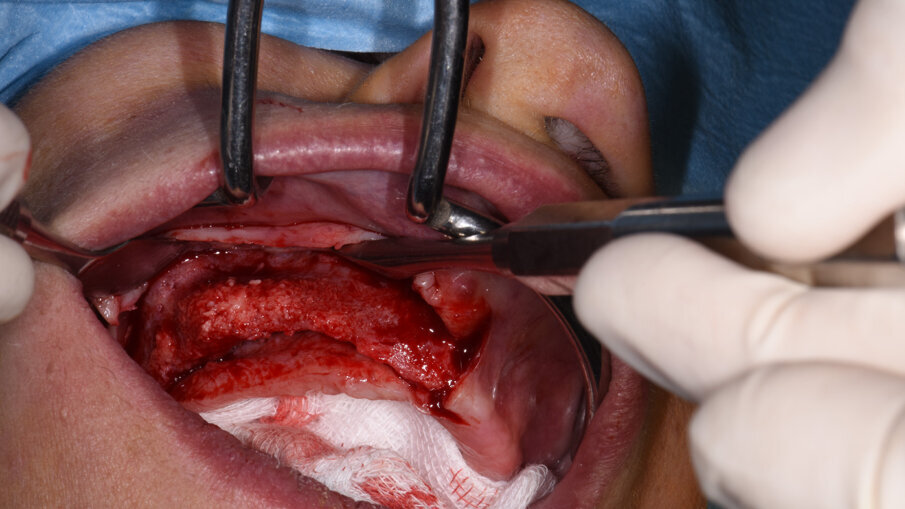 Obr. 7a, b: Výsledek první horizontální augmentace na pravé straně (a) a na levé straně (b).