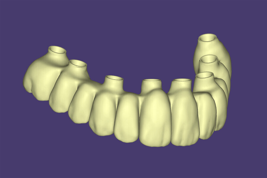Fig. 5i: Virtual design of the Misch classication FP-1 restoration in exocad.