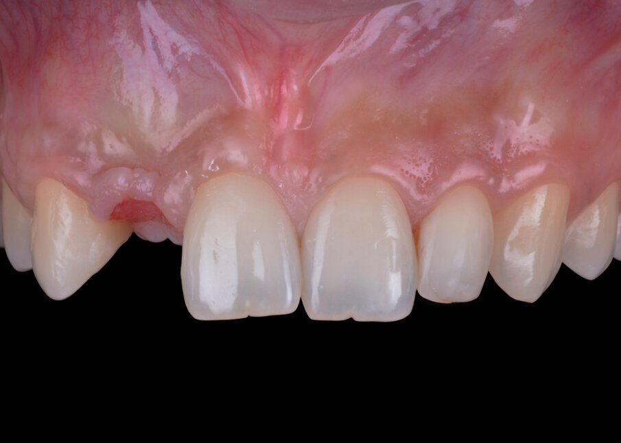 Fig. 10 - Situazione clinica a 6 mesi dell’inserimento dell’impianto.