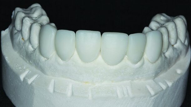 Sans stress (vraiment !)Facettes en résine nanocéramique