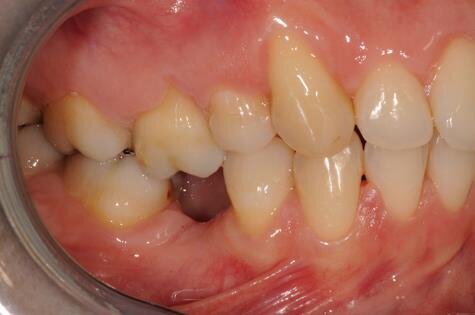 Figg. 2a-2c - Foto intraorali pretrattamento: visioni frontale (a), laterali (b).