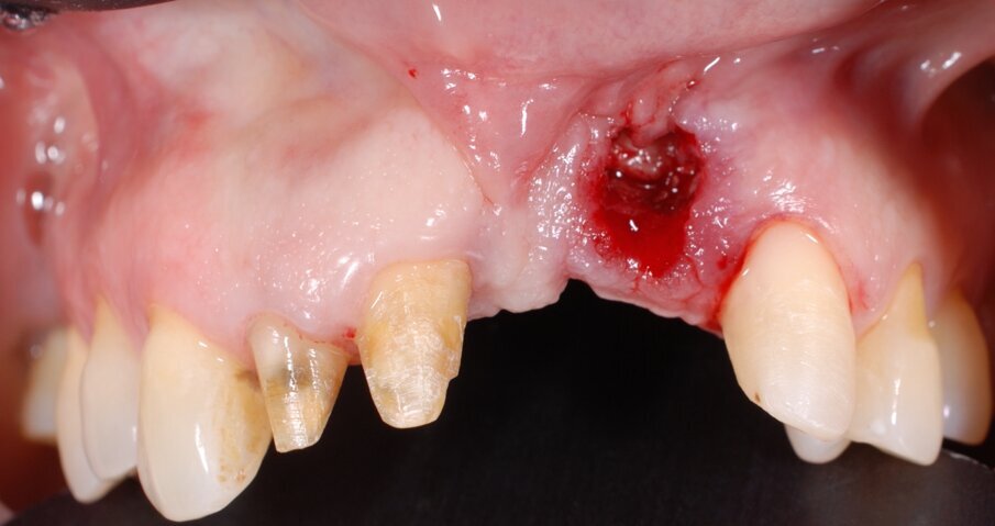 Fig. 5 - Rimozione atraumatica dell’impianto con l’utilizzo dello svitatore.