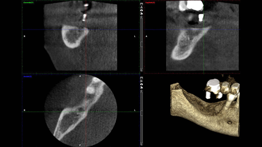 Figg. 1a-1c_Foto clinica e sezioni di CBCT iniziali in cui si evidenzia edentulia distale all’elemento 4.5 con atrofia tridimensionale.