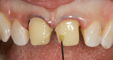 Un innovativo protocollo  di cementazione adesiva