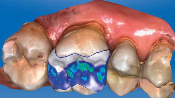 Restauri protesici singoli eseguiti con metodica CAD/CAM chairside