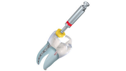 Webinar: Herausforderungen der Aufbereitung gekrümmter Wurzelkanäle Webinar: Herausforderungen der Aufbereitung gekrümmter Wurzelkanäle