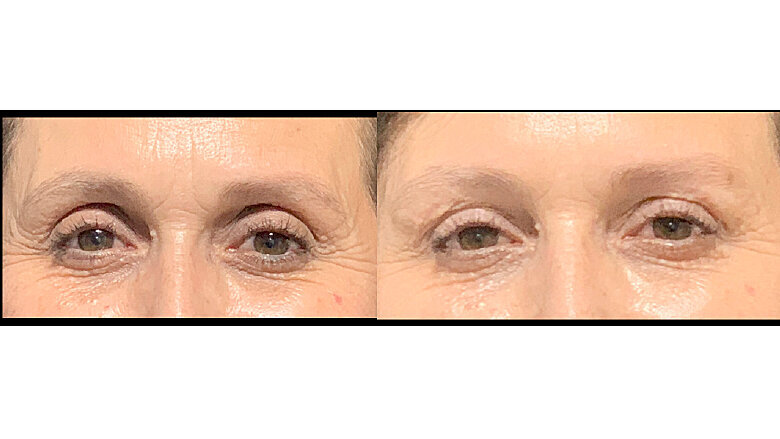 Foto 10. Control de desmejoramiento y relleno de párpado superior.
