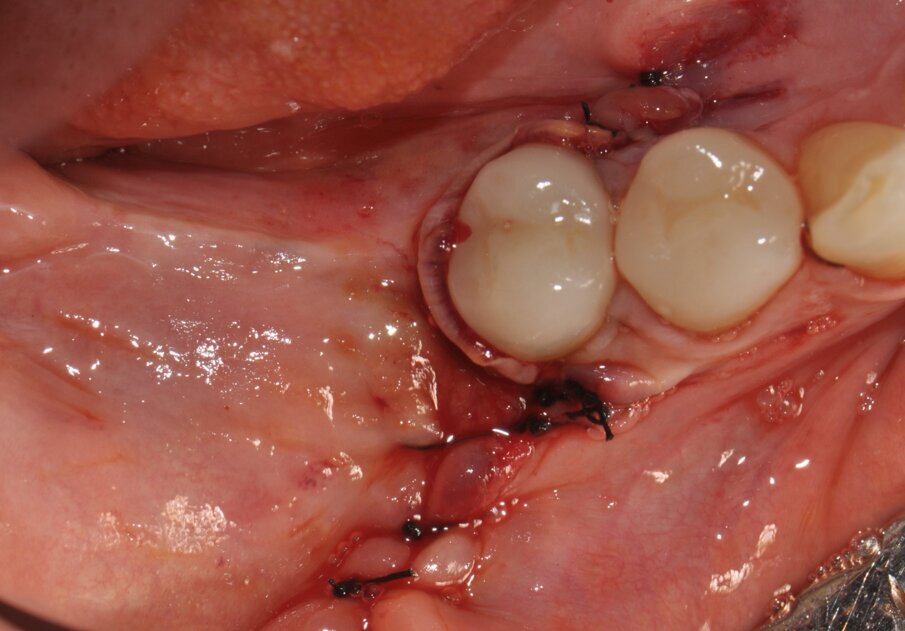 Figg. 7, 8_La membrana Cytoplast viene fissata vestibolarmente ed il lembo viene suturato.