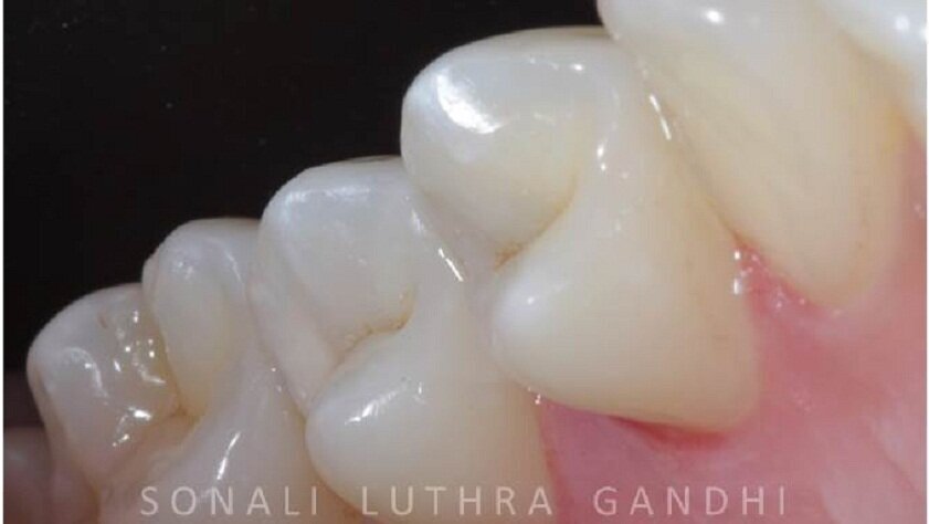 Management of proximal posterior lesions: A case report