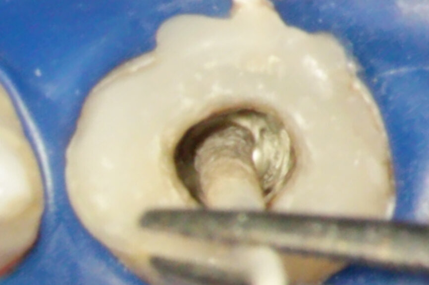 Fig. 2e: (a) Endodontically treated tooth with fistula. (b) After retreatment, the tooth showed an open apex. (c) MTA application with the MAP System and PD MTA White. Condensation of the MTA with pluggers (d) or paper points (e). (f) MTA plug. (g) Post-op radiograph showing the MTA plug and the reconstruction with a fibre post.