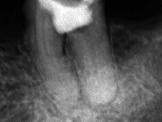 Fig. 1: Initial clinical and radiographic appearance of teeth 36