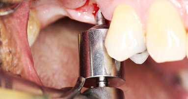 Dva v jednom: Pilotní vrták a chirurgická šablona