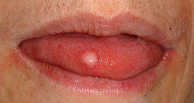 Fibrome in der zahnärztlichen Chirurgie – mit dem Laser einen Schnitt voraus