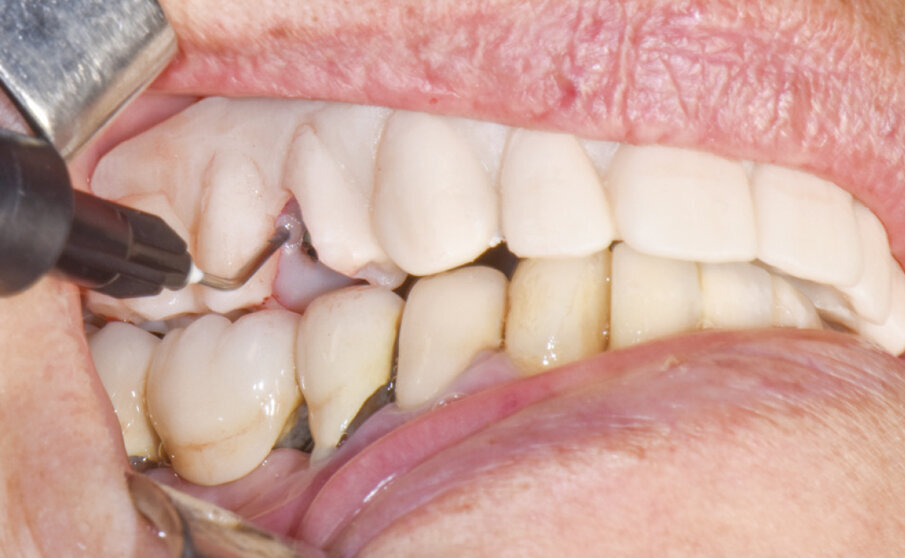 Fig. 7 - Controllo del rapporto occlusale e fissaggio dei cilindri alla struttura.