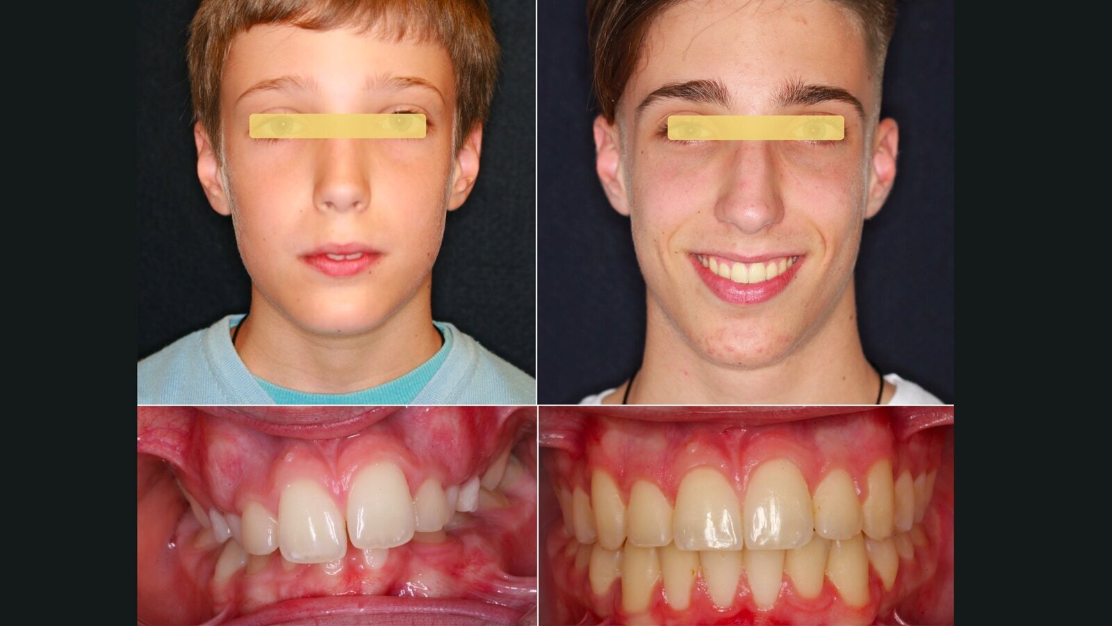 ¿Extracción o Expansión en Ortodoncia? (1)