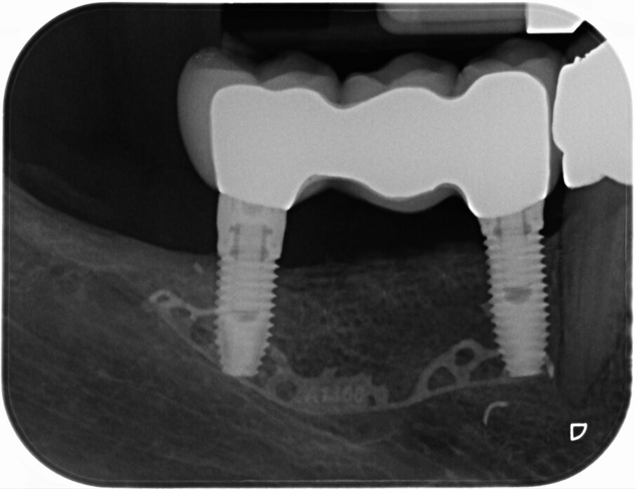 Figg. 12a, 12b_Immagine clinica e radiografica che mostrano il manufatto protesico finale. 