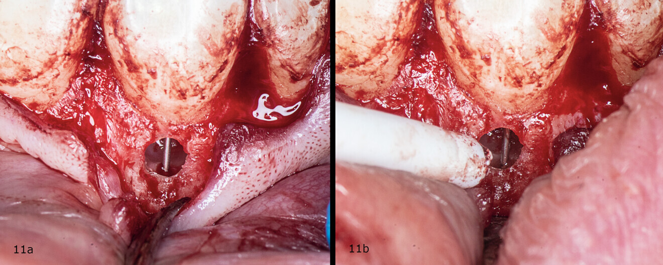 Figs. 11a & b: Irrigation of the root canal.