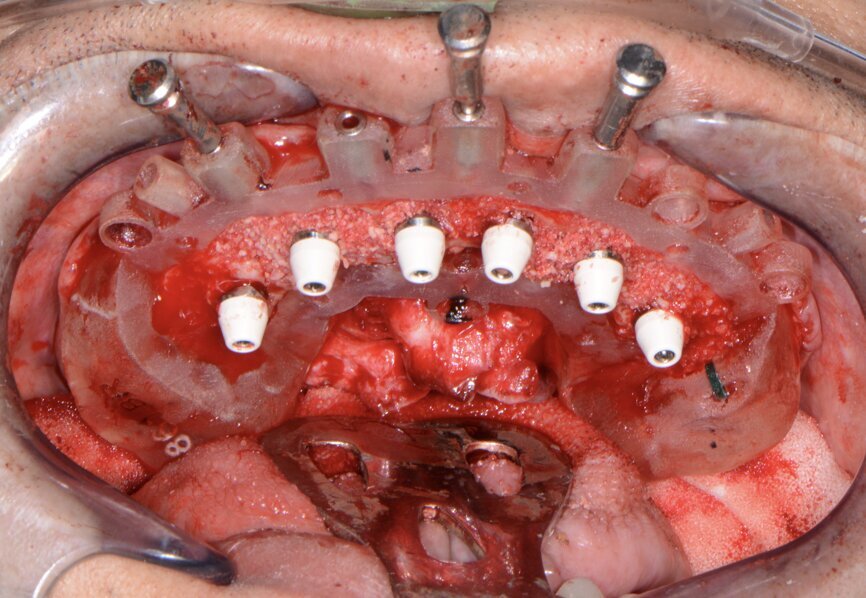 Fig. 13: Implants with corresponding multi-unit abutments.