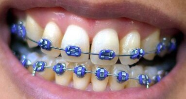 Aparat ortodontyczny – nie tylko dla dzieci i młodzieży