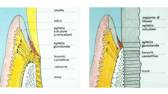 La mucosità perimplantare e la perimplantite: il loro ruolo nella patologia implantare