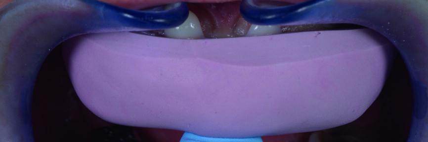 Fig. 10 : Préparation d’un mock-up intra-oral au moyen d’une clé en silicone. 
