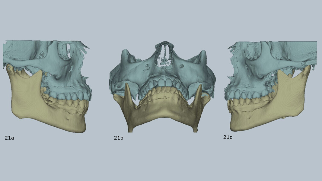 Figs. 21a–c: Pretreatment virtual articulator mounting with MODJAW demonstrating a discrepancy between maximum intercuspation and centric occlusion.