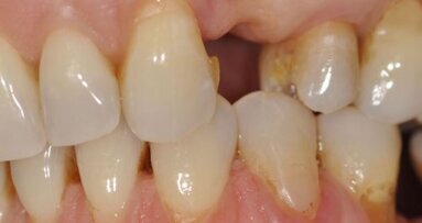 Pogrubienie dziąsła zrogowaciałego w odcinku estetycznym w leczeniu implantologicznym