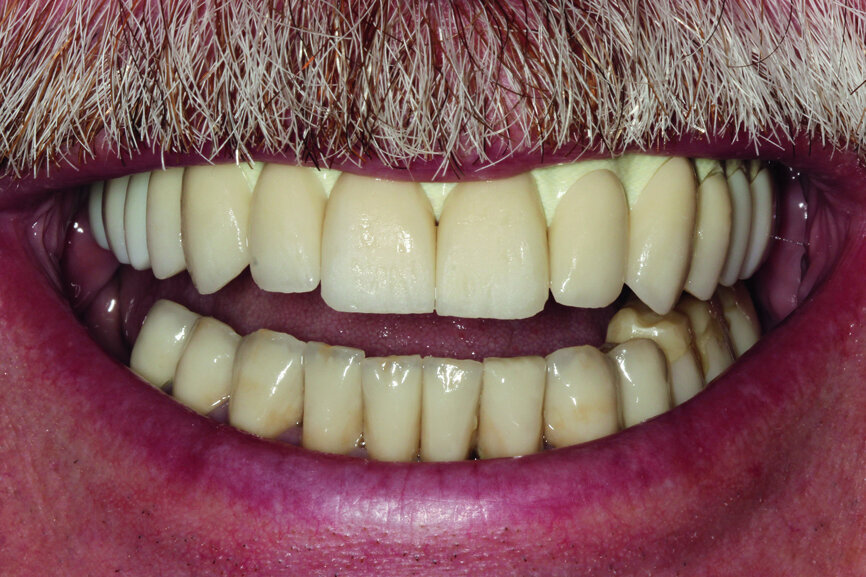 Fig. 16: Maximum smile of the patient with crowns.