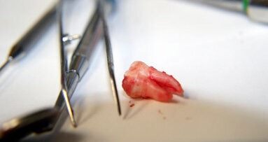 Thousands of teeth may unnecessarily be pulled for profit in UDA system