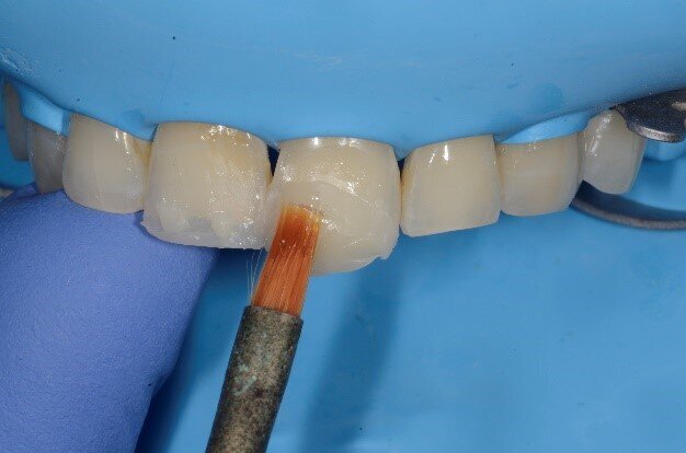 Fig 9: The most conservative treatment modality can then be chosen to restore anterior teeth keeping in mind the age, needs and habits of the patient