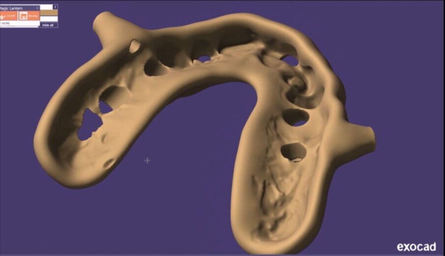 Figg. 26-28_Progettazione Cad con exocad.