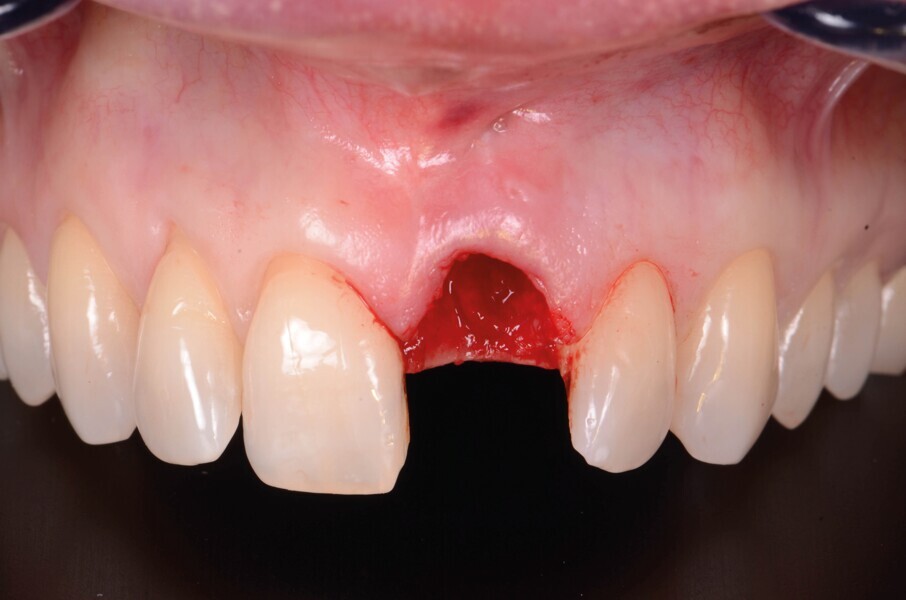 Fig. 5b : Après l’extraction