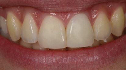 Stratification simplifiée en composite réalisée sous éclairage albédo LED D65 et sans scialytique