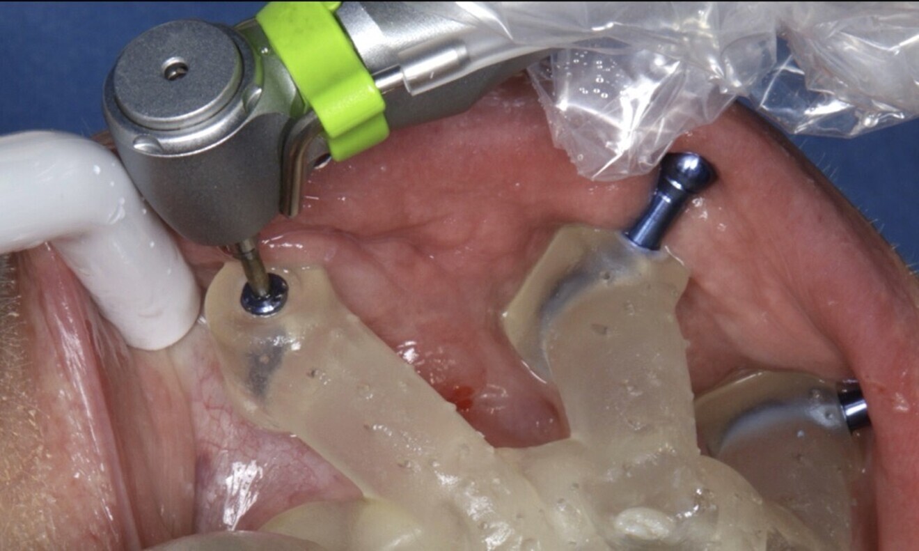 Figs. 30 & 31: The tooth-supported surgical guide was placed in the mandible and the anchor pins inserted.