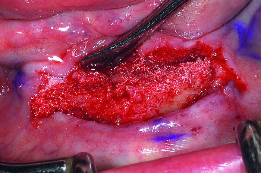 Fig. 18a: A resorbable calcium apatite bone grafting material was used to fill voids and cover the implant—followed by applications of platelet-rich fibrin (PRF).
