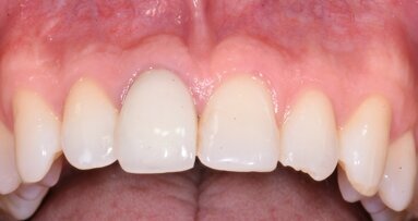 Resonance frequency analysis—the only longitudinal metric for implant stability