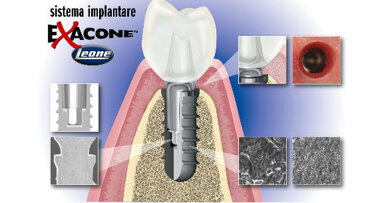 Sistema implantare Exacone: 10 anni di successi