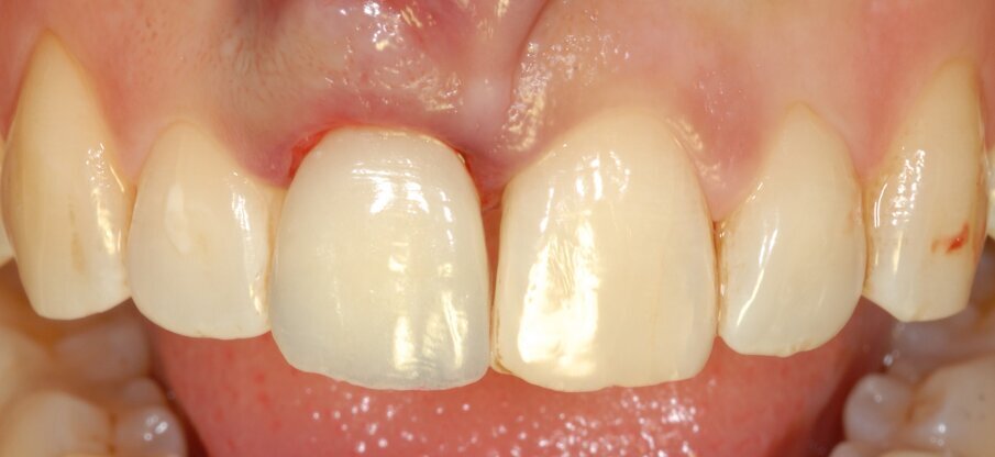 Fig. 4 - Il provvisorio appena avvitato al termine della chirurgia.