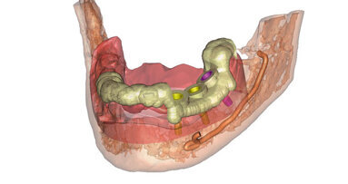 CAMLOG vereinbart Zusammenarbeit mit Materialise Dental und SICAT