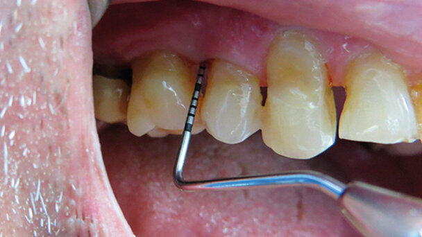 L’utilizzo della terapia fotodinamica HELBO  nella parodontopatia