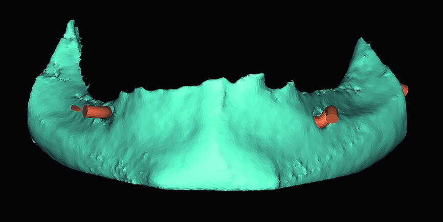 Fig. 7: 3-D volumetric reconstruction from CBCT data.