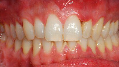 Gestione multidisciplinare del paziente affetto da gengivite ulcero-necrotica